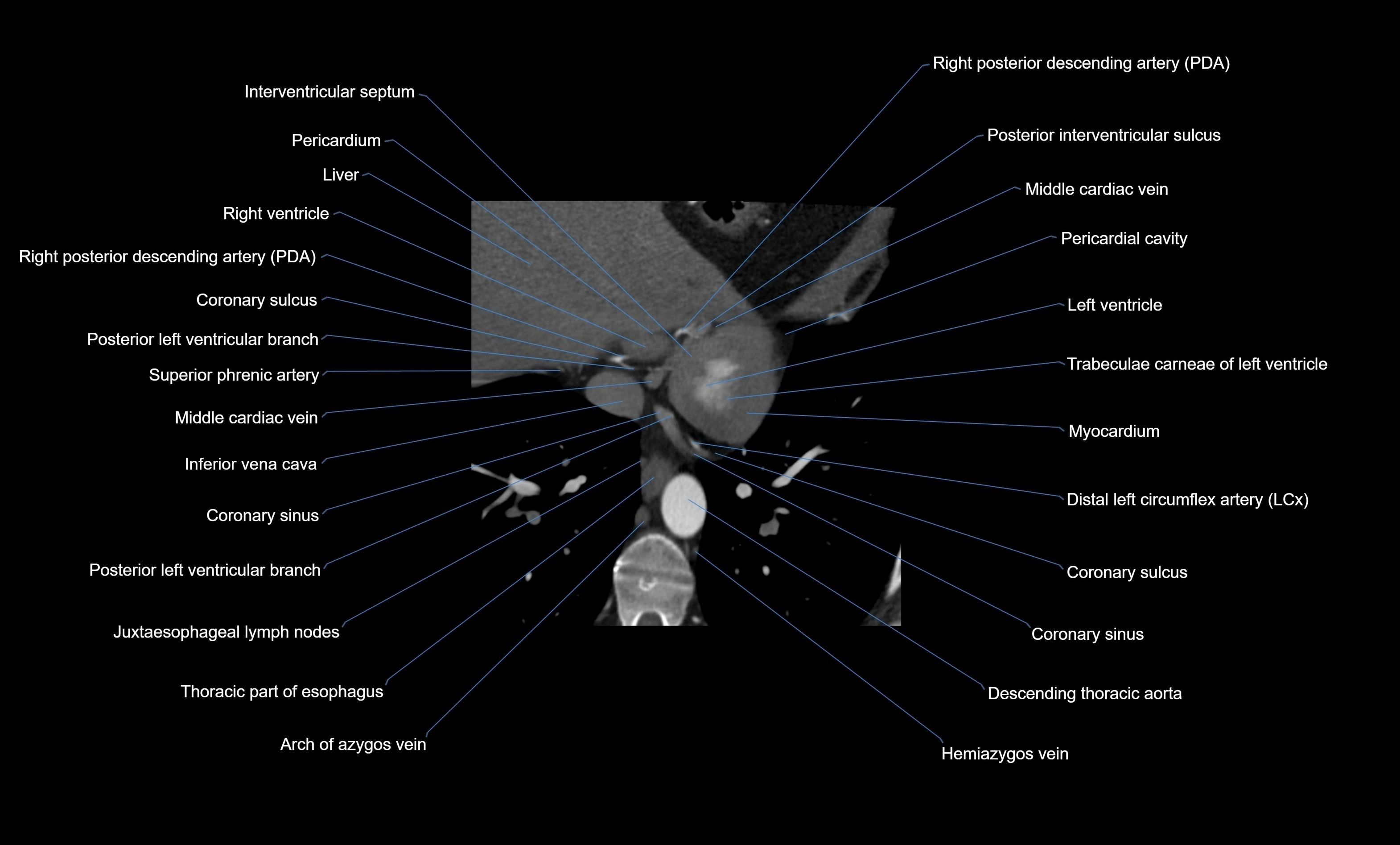 CT heart (coronary angiogram) four chamber view  cross sectional anatomy labelled radiology image -00039.webp